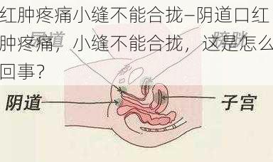 红肿疼痛小缝不能合拢—阴道口红肿疼痛，小缝不能合拢，这是怎么回事？