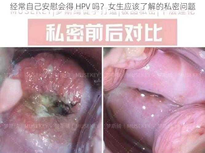 经常自己安慰会得 HPV 吗？女生应该了解的私密问题