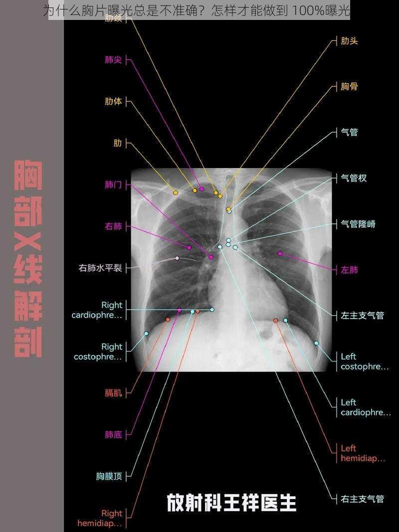 为什么胸片曝光总是不准确？怎样才能做到 100%曝光？